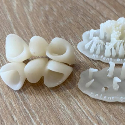 3D печать временных коронок