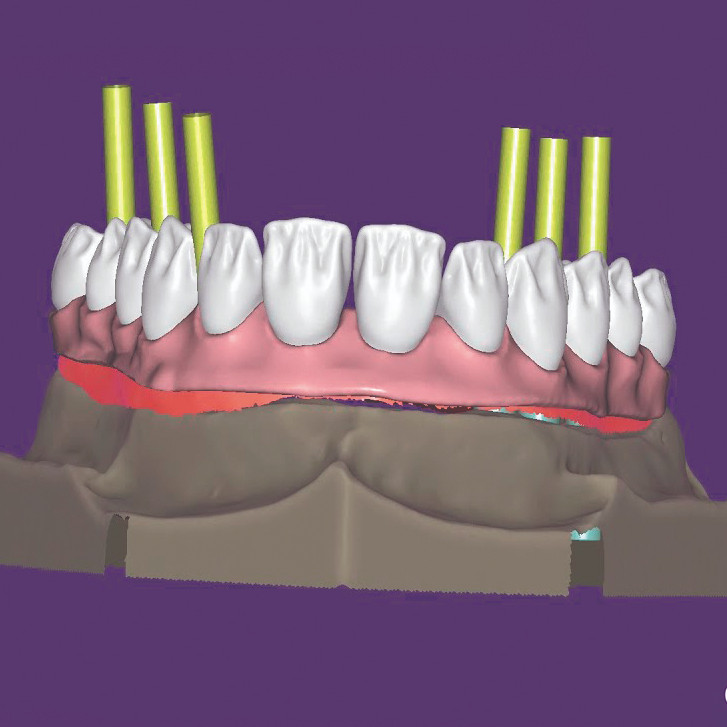 Модуль 2. Exocad. Роботи на імплантах - CAD CAM Academy, Product ...